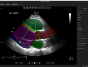 SONIX HEALTH - AI 기반 자동 심초음파 영상분석 솔루션